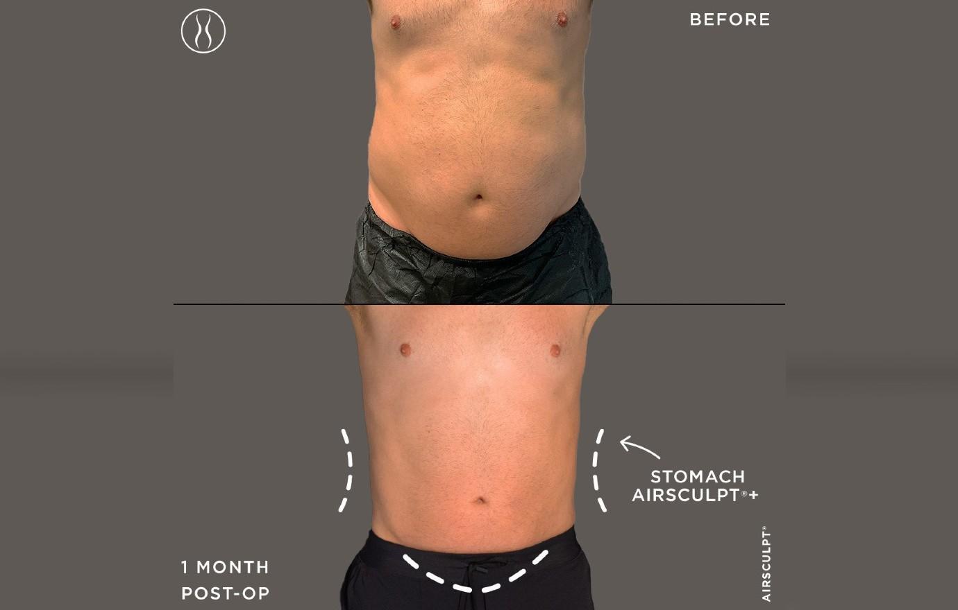 Which AirSculpt® Procedures Can Get My Belly Summer Ready?