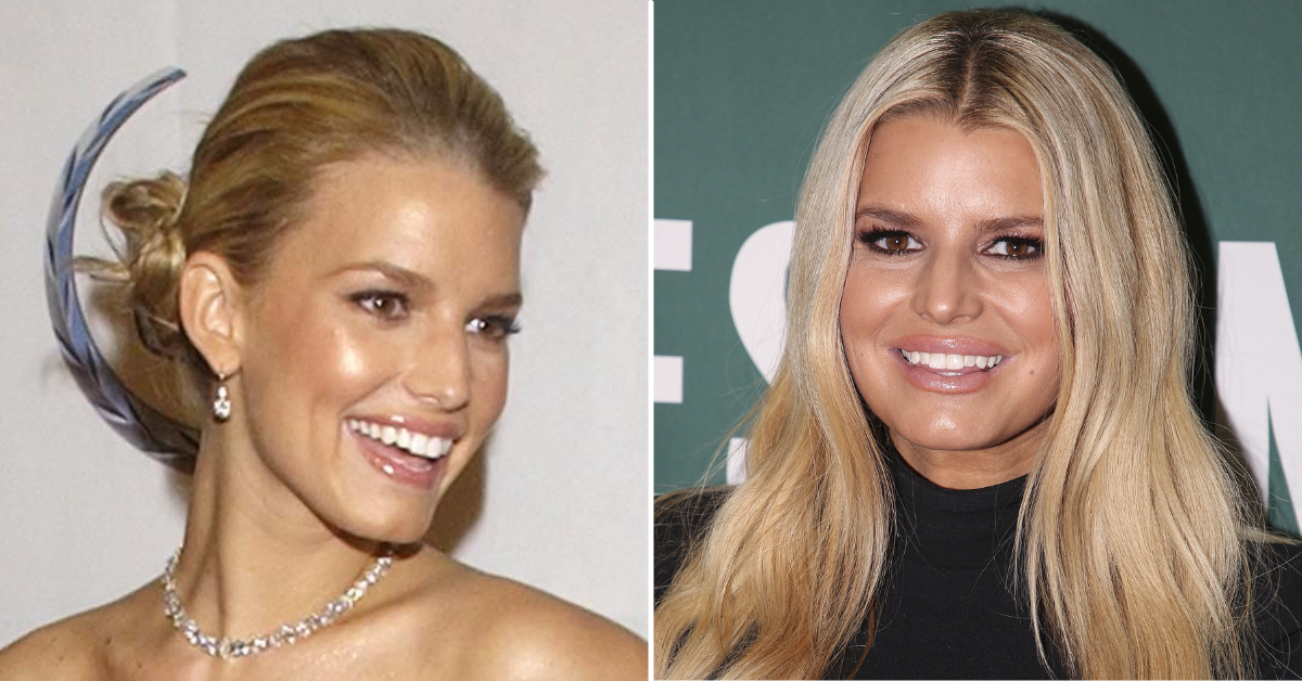 All The Celebs Who Took Face Fillers Too Far, Photos