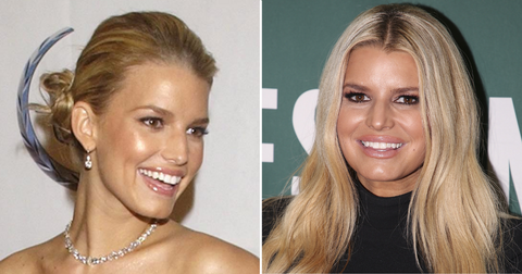 All The Celebs Who Took Face Fillers Too Far, Photos