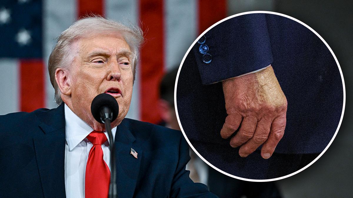 Image of Donald Trump's bruised hands and rambling continue to fuel speculation about his health.