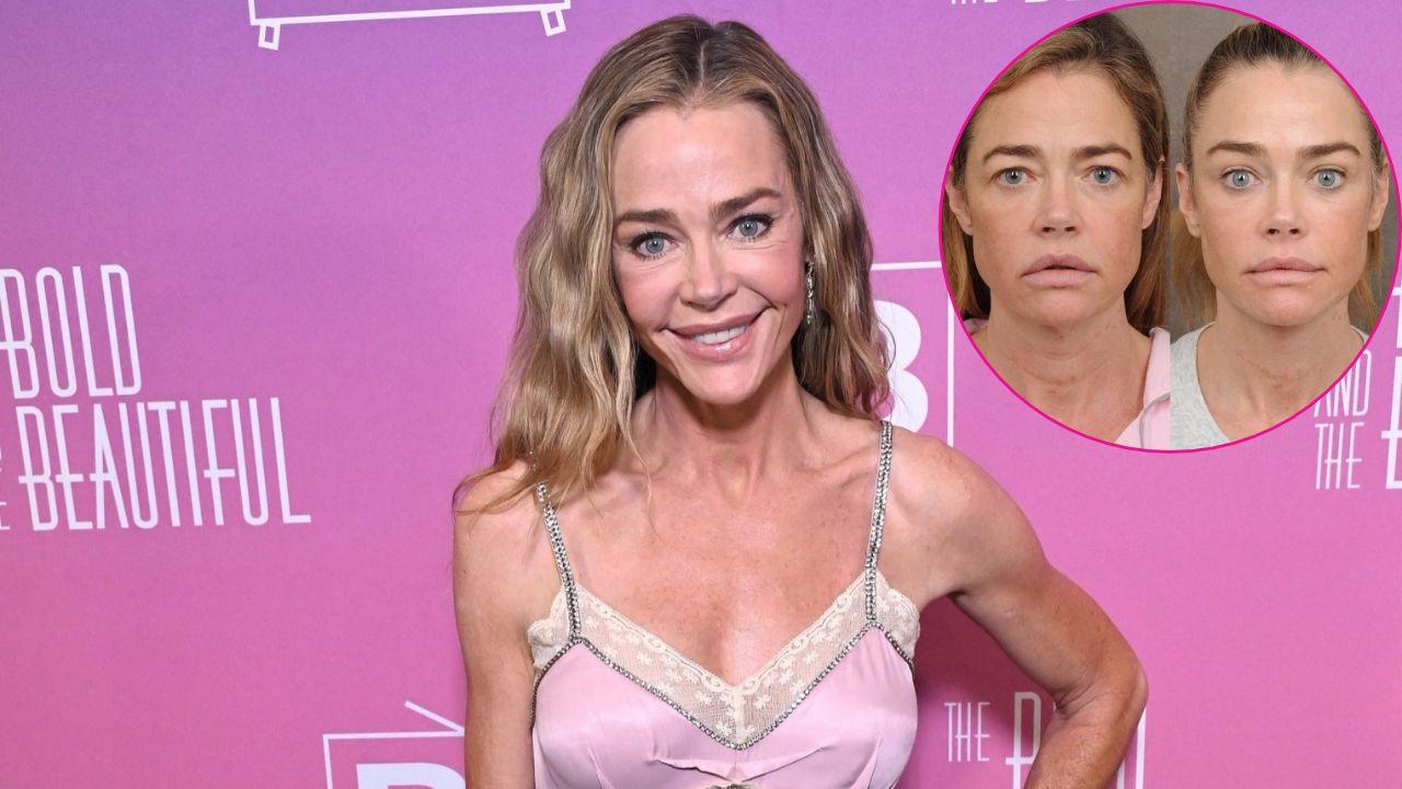 Image of Denise Richards and (inset)  before and after facelift. 