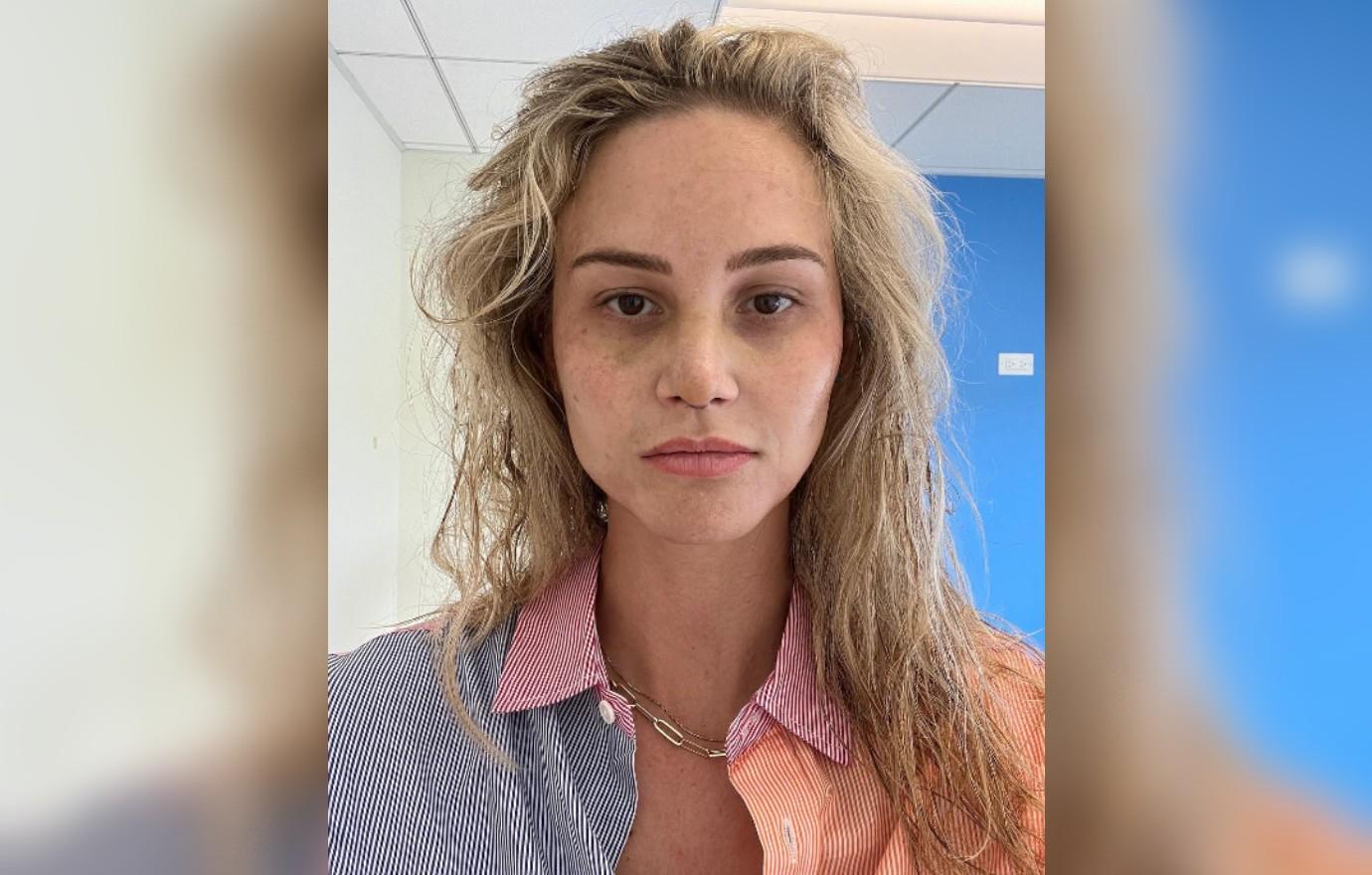 Meghan King Posts Photos After Plastic Surgery For Chest Nose