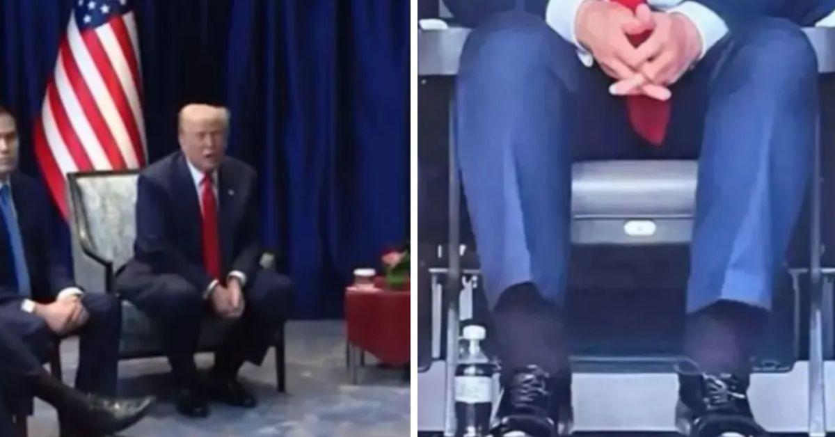 image of Donald Trump has chronic venous insufficiency.