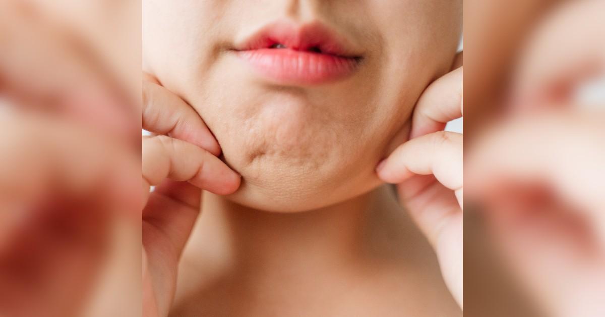 understanding facial puffiness and lymphatic drainage