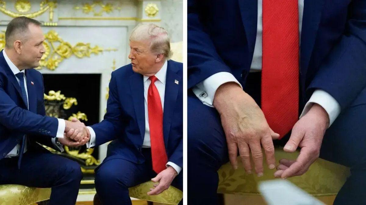 Photo of The POUTS tries to conceal his bruised hands with makeup.