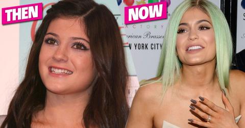 Kylie jenner veneers teeth