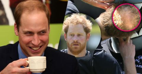 Prince harry going bald hair loss charles william 04