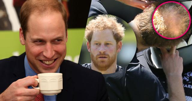 Prince Harry Going Bald After Years Of Poking Fun At Brother Prince ...