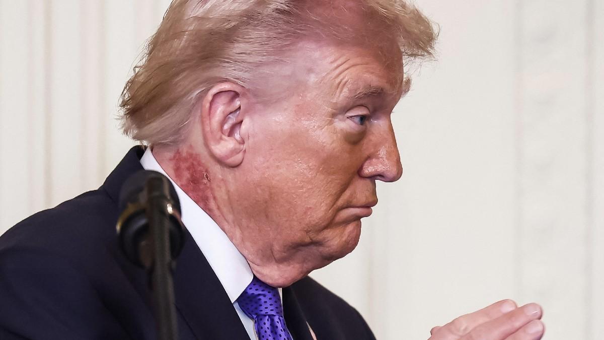 image of Donald Trump stepped out with a neck rash recently. 