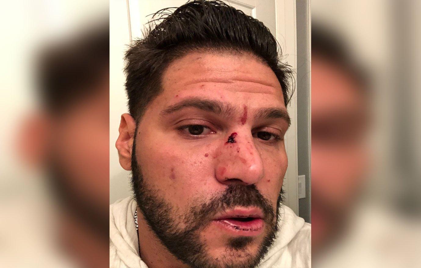 Ronnie Ortiz-Magro Injuries Jen Harley Domestic Violence Charges Dropped