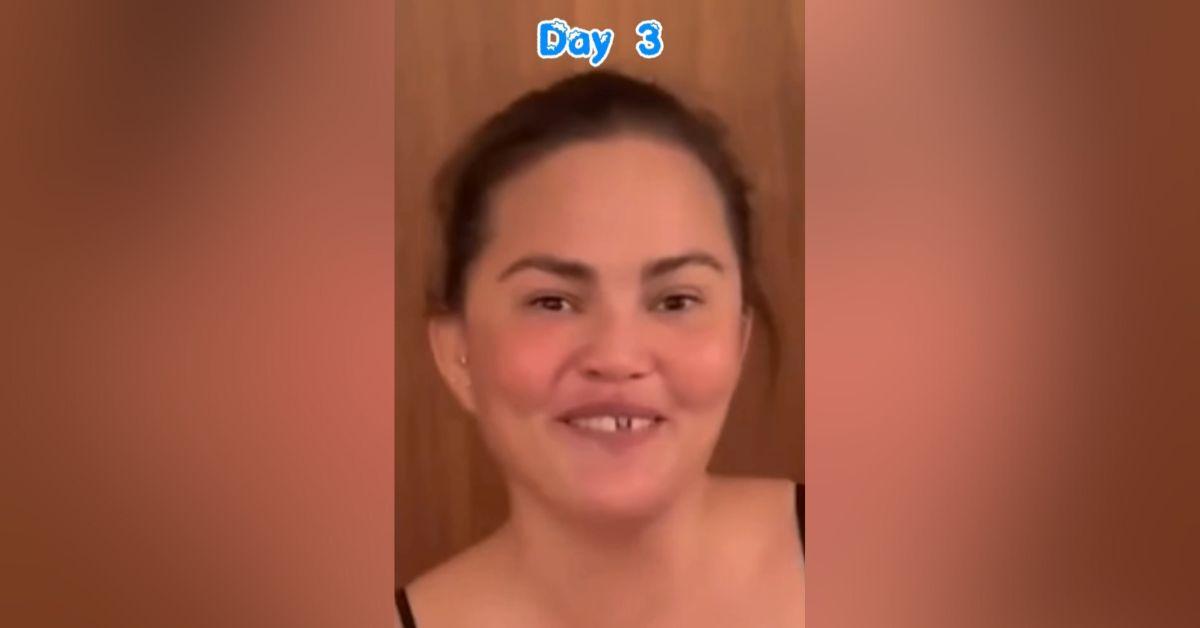 Image of Chrissy Teigen went to the doctor to get her veneer put back in.