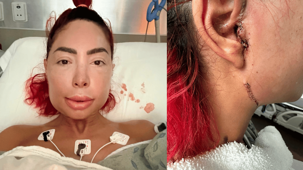 Image of Farrah Abraham shared a graphic close-up of stitched extending from around her ear toward her jaw.