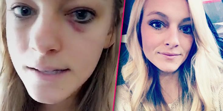 Teen mom mackenzie mckee snapchat bruise h