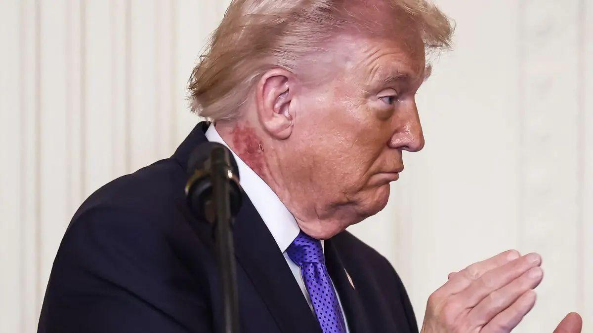 Photo of Donald Trump was seen with a rash on his neck on March 5.