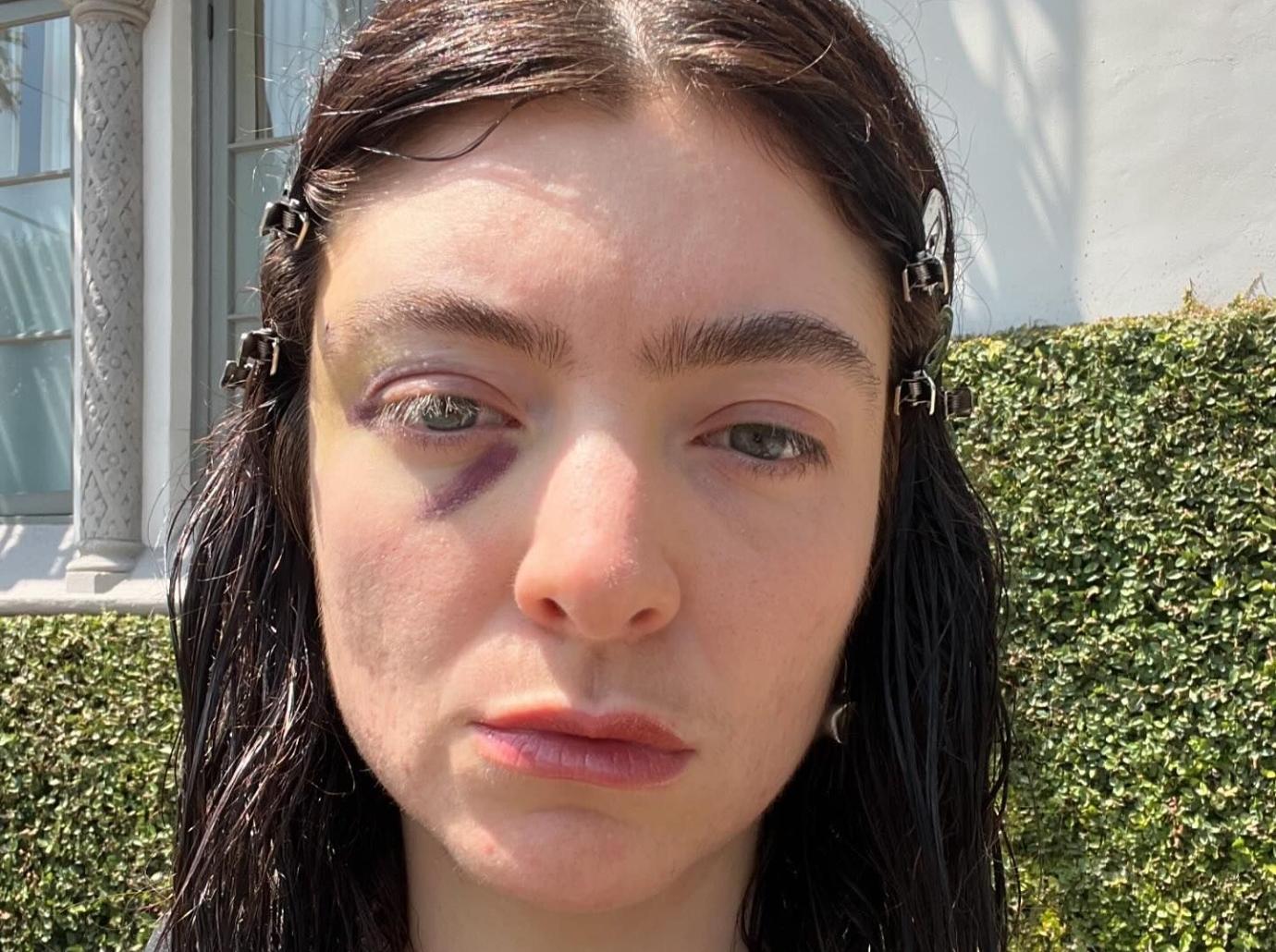 lorde worries fans photos bruised black eye deleting instagram posts