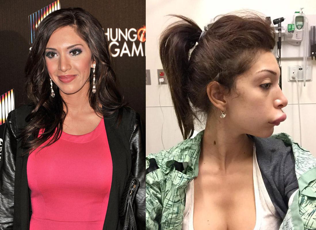 1 farrah abraham plastic surgery SPL