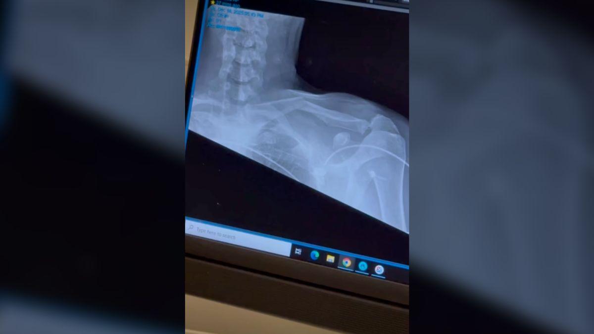 image of He credited the accident to user error while reflecting on the scary moment.