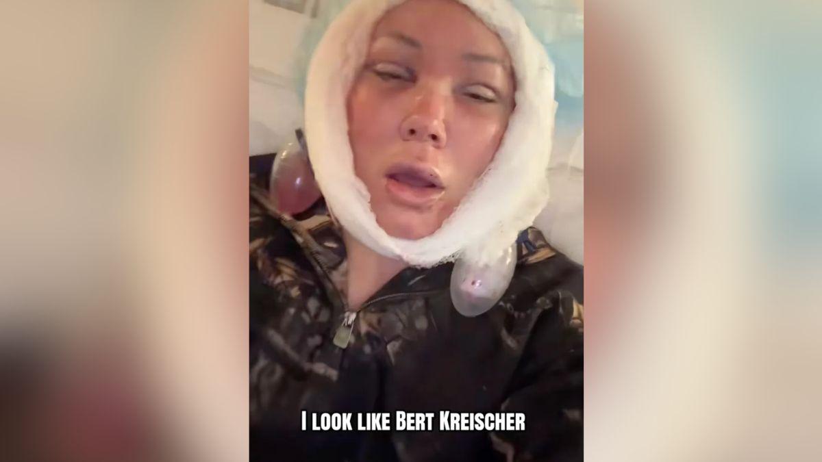 image of She shared her face still looks 'different' every day due to post-procedure swelling that can last months.