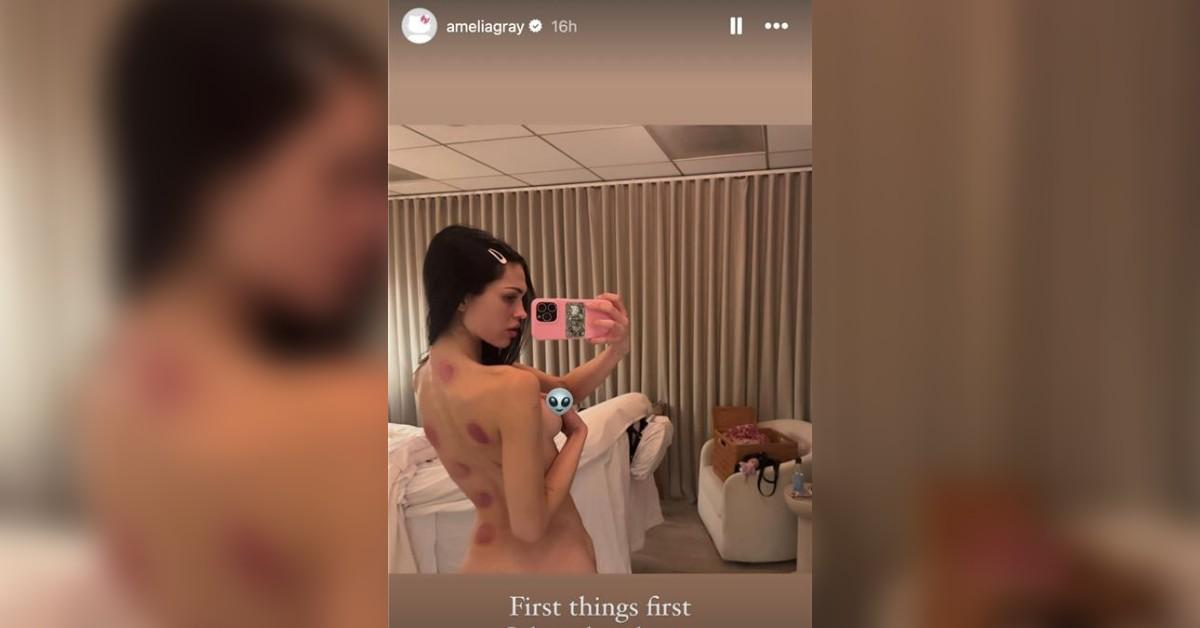 lisa rinna daughter amelia gray naked selfie cupping therapy photo