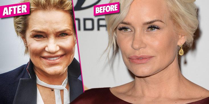 Yolanda hadid no botox plastic surgery before after photos HERO 01