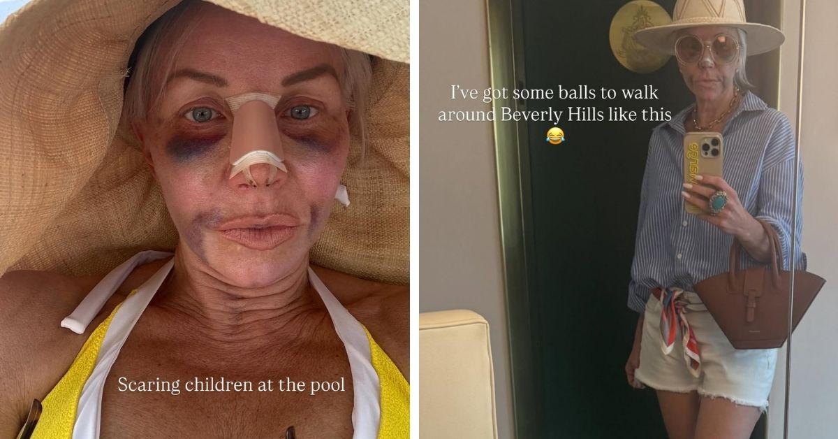 image of The reality star also had fat transfer and stem cell treatments on her face.