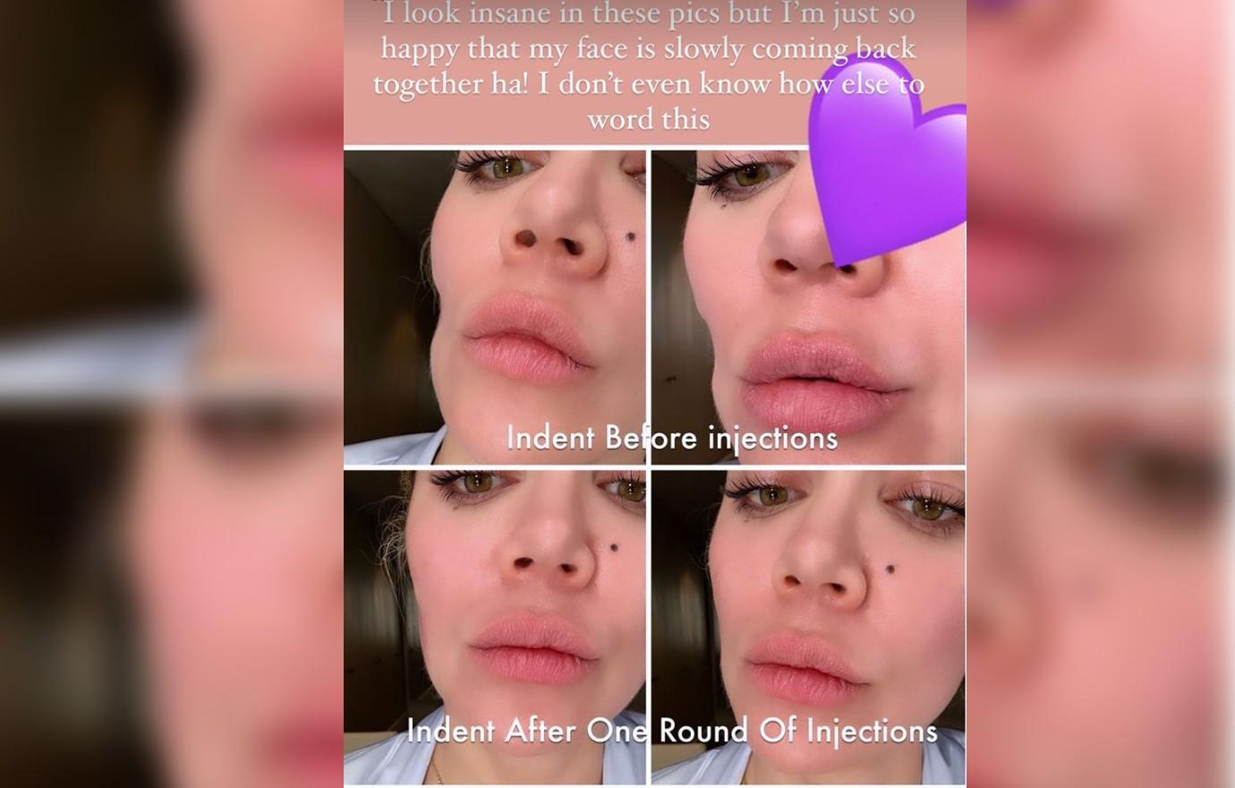 Khloe Kardashian's stitches from scary face surgery revealed in graphic new  unedited video amid cancer scare