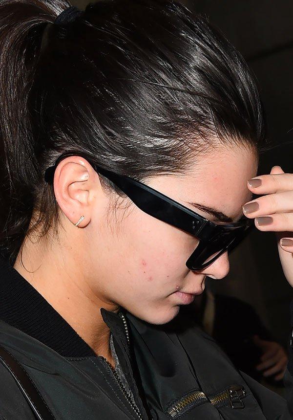 Kendall jenner acne pimples004