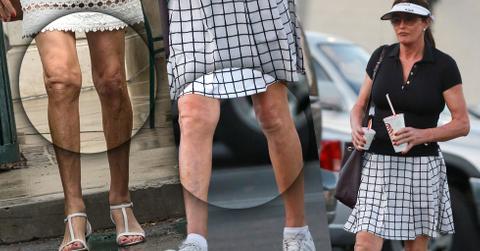 caitlyn jenner surgery knee lift legs