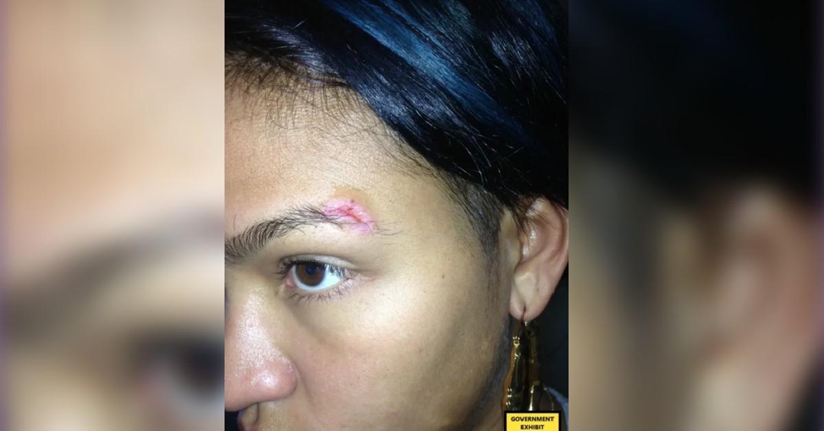 cassie ventura eye gash stitches sdny credit