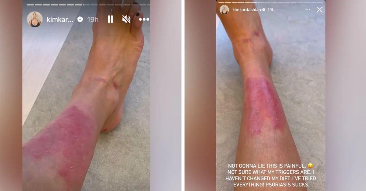 kim kardashian health woes timeline psoriasis brain aneurysm more