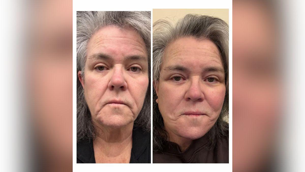 Image of Rosie O'Donnell posted before-and-after photos of her facelift.