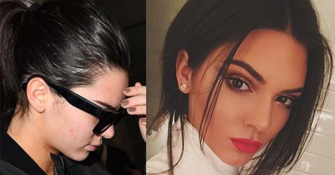 02 kendall jenner acne