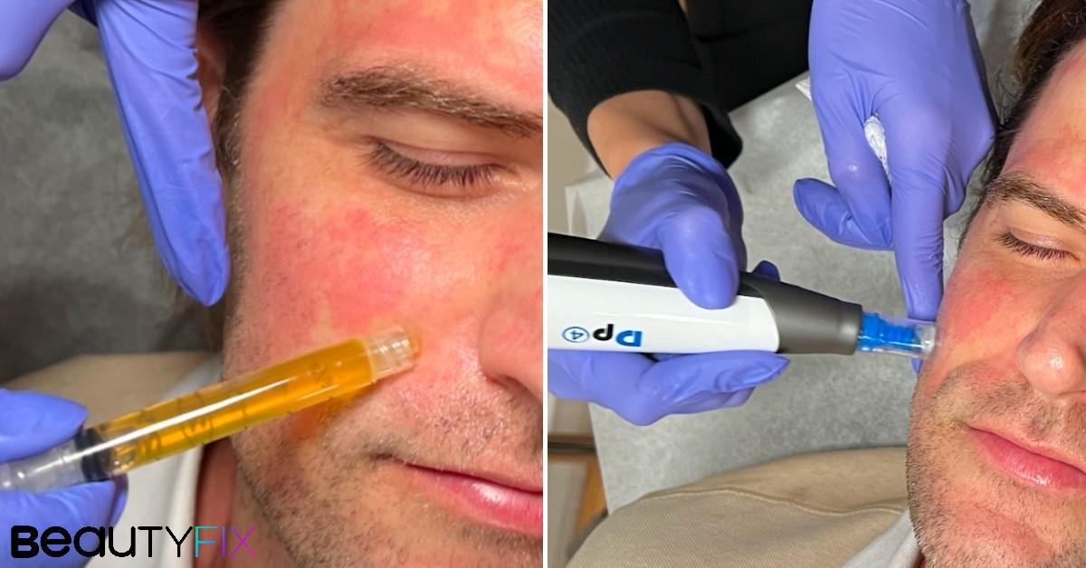 PRP Microneedling been administered at BeautyFix Medspa, NYC.