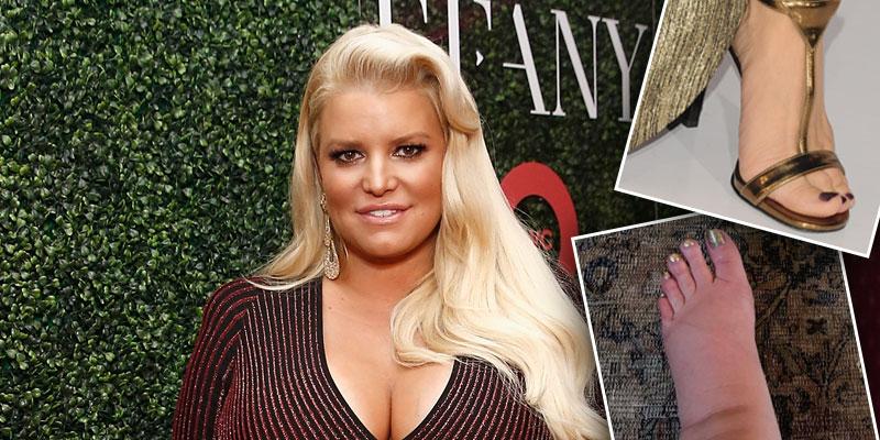 Jessica Simpson Finds Remedy for Extremely Swollen Foot