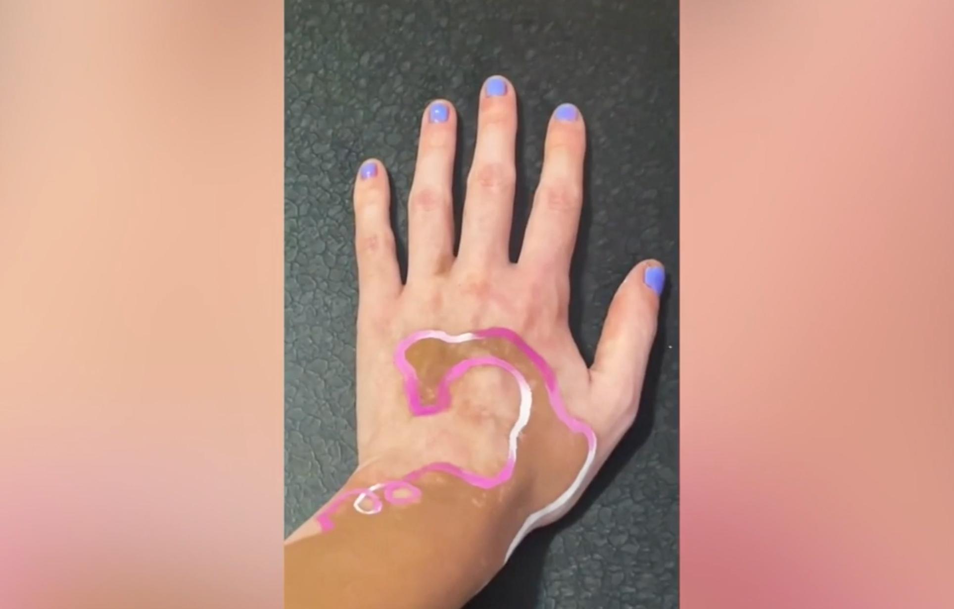 rhode island woman uses her vitiligo spots