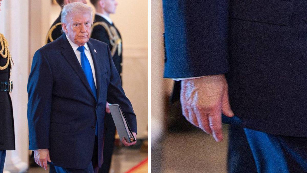 image of Donald Trump covered up his bruised hand with makeup again.