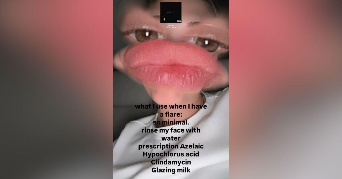 image of The model shared her go-to products for flare-ups.