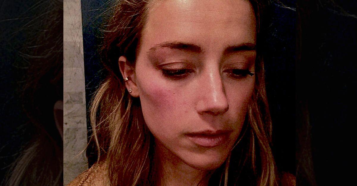 amberheard bruised