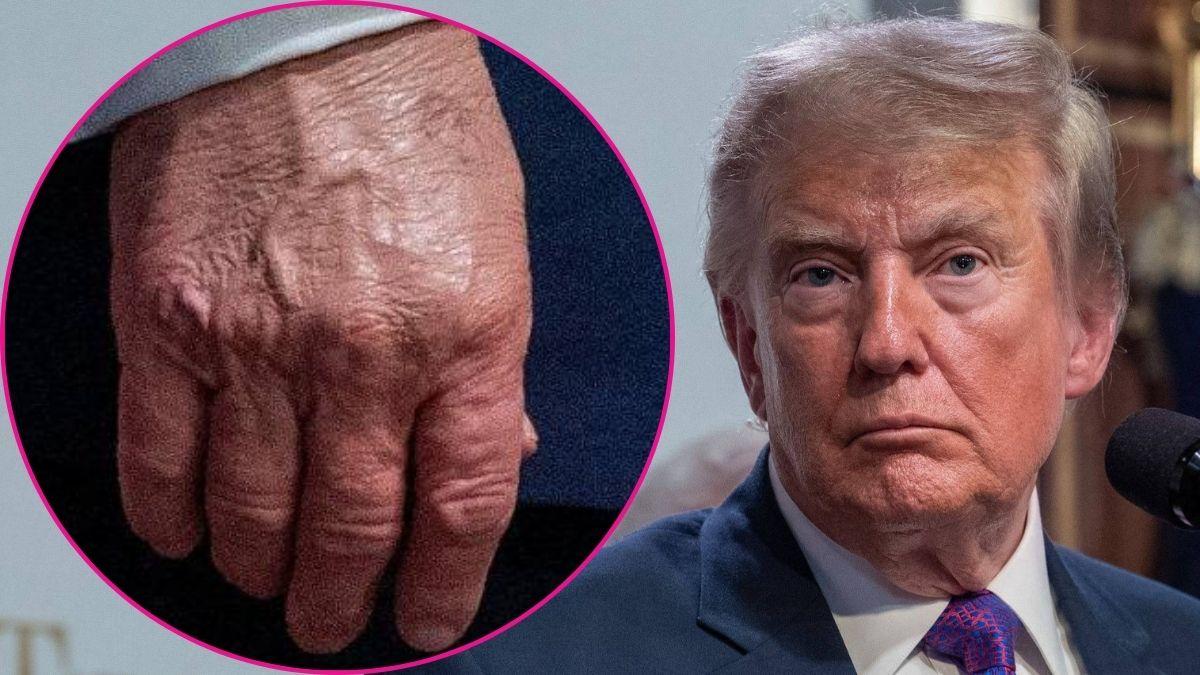 Composite photo of Donald Trump and his hand.