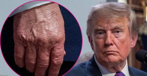Composite photo of Donald Trump and his hand.