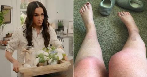 Photo of Meghan Markle; picture of fan's burns.