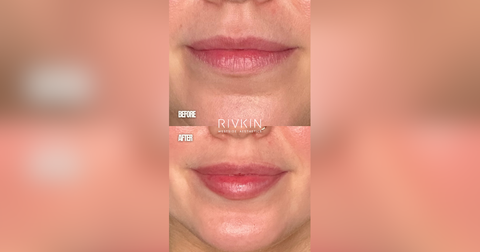 Love Island's Hannah Fields' Rivkin Aesthetics Filler Transformation