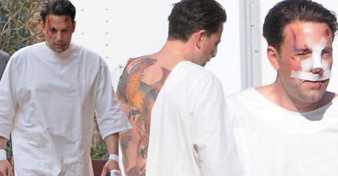 Ben Affleck Plastic Surgery Bruises