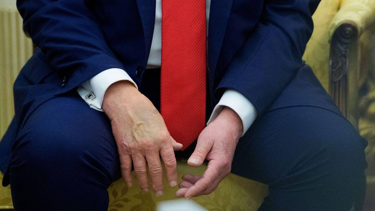 Photo of The president often tries to conceal his hand bruise with makeup.