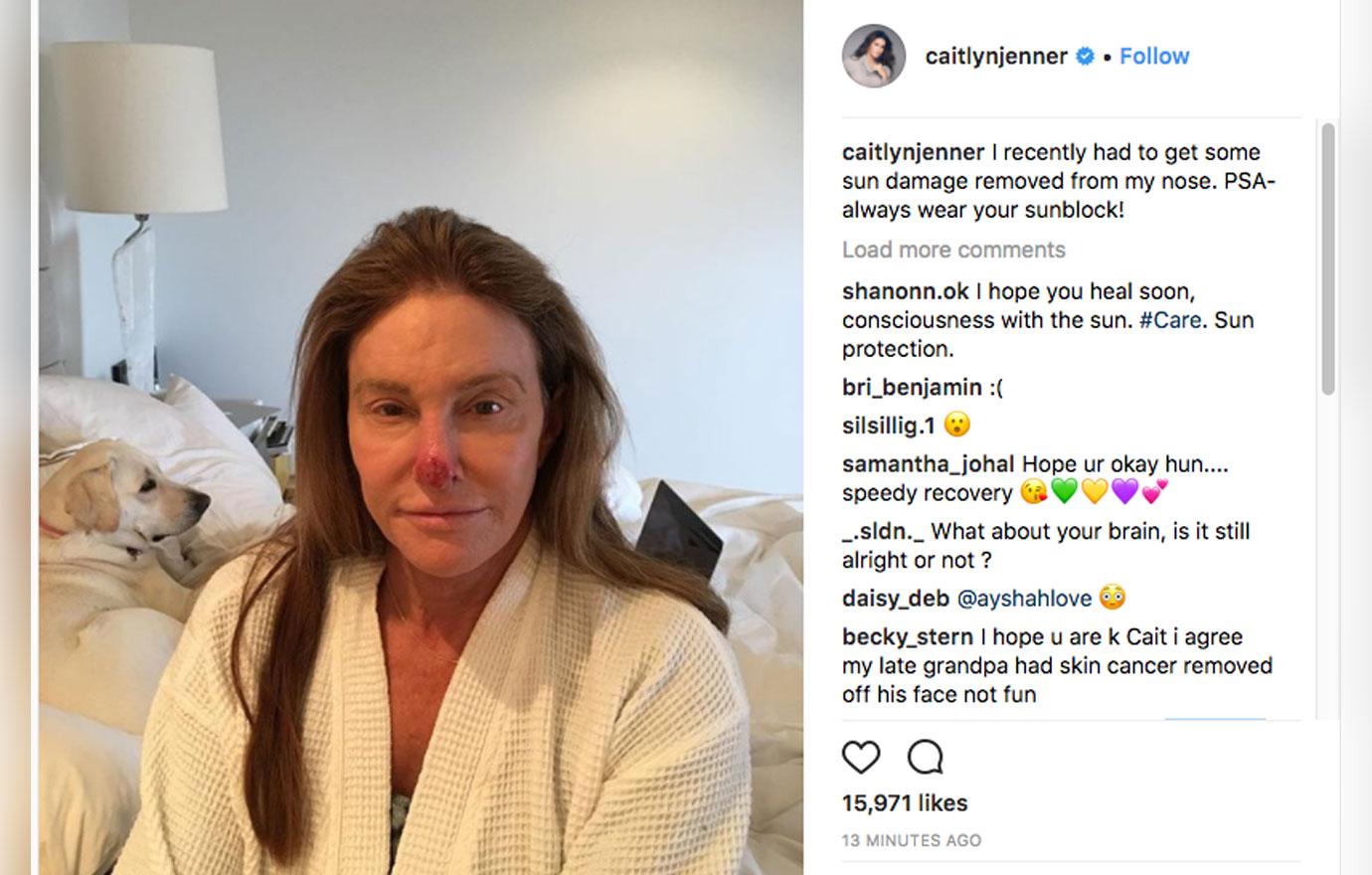 Caitlyn jenner graphic sun damage 1