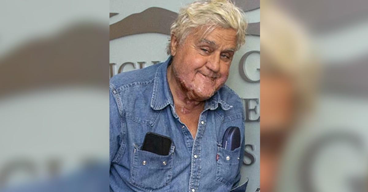 Jay Leno Shows Off Face Scars As He's Discharged From Burn Center