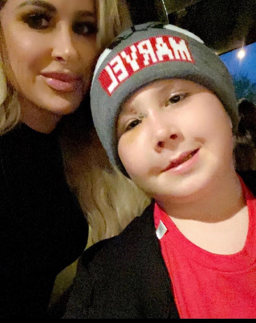 rhoa-kim-zolciak-son-kash-reconstructive-surgery-dog-bite-face.03