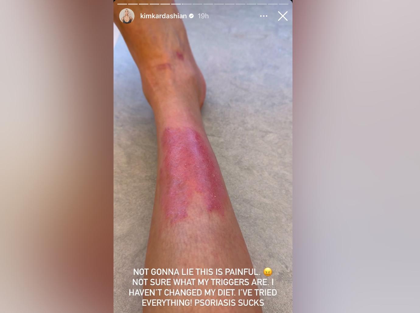 Kim Kardashian Struggling With 'Painful' Psoriasis Flare-Up: Photos