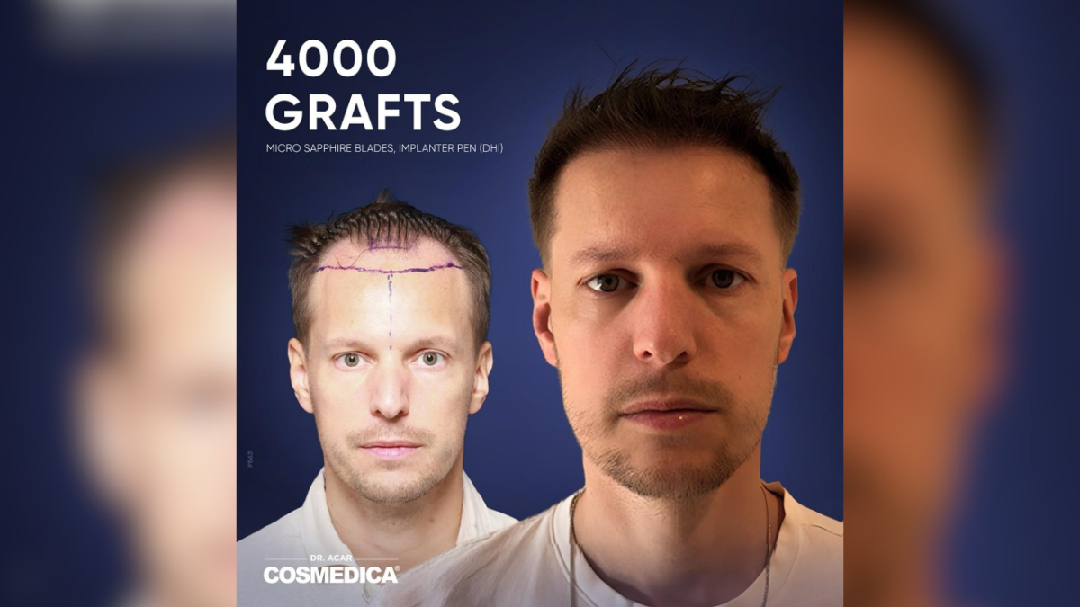 hair transplant in turkey a closer look at cost care and results