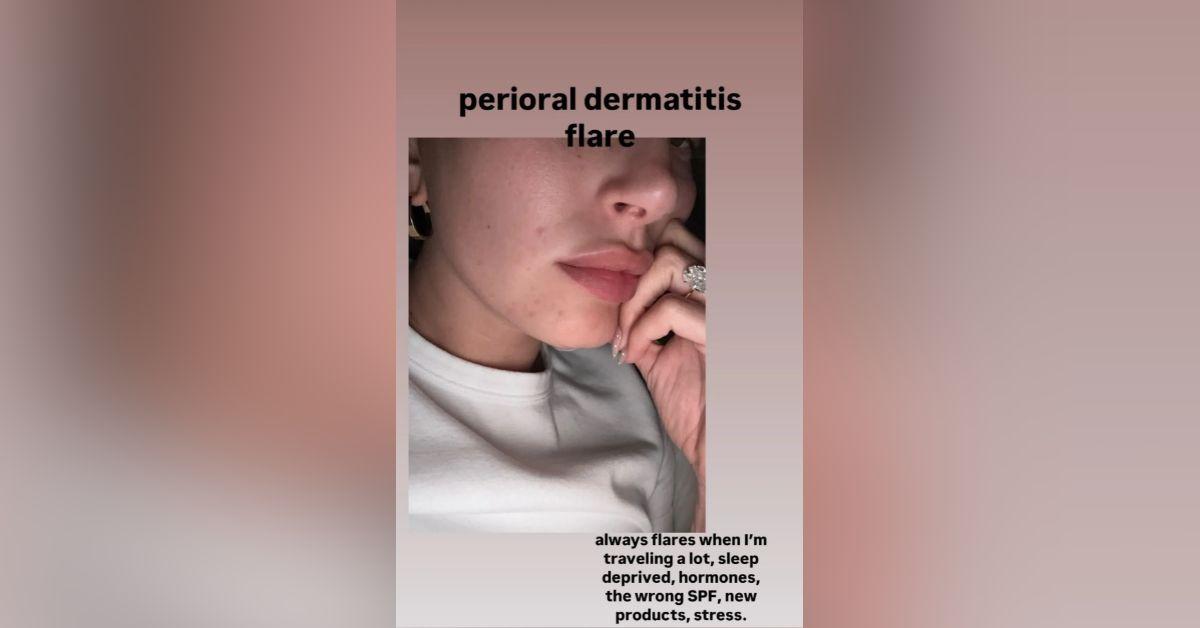 image of Hailey Bieber kept it honest with fans about her skin.